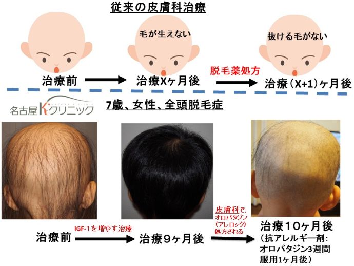円形脱毛症　病院